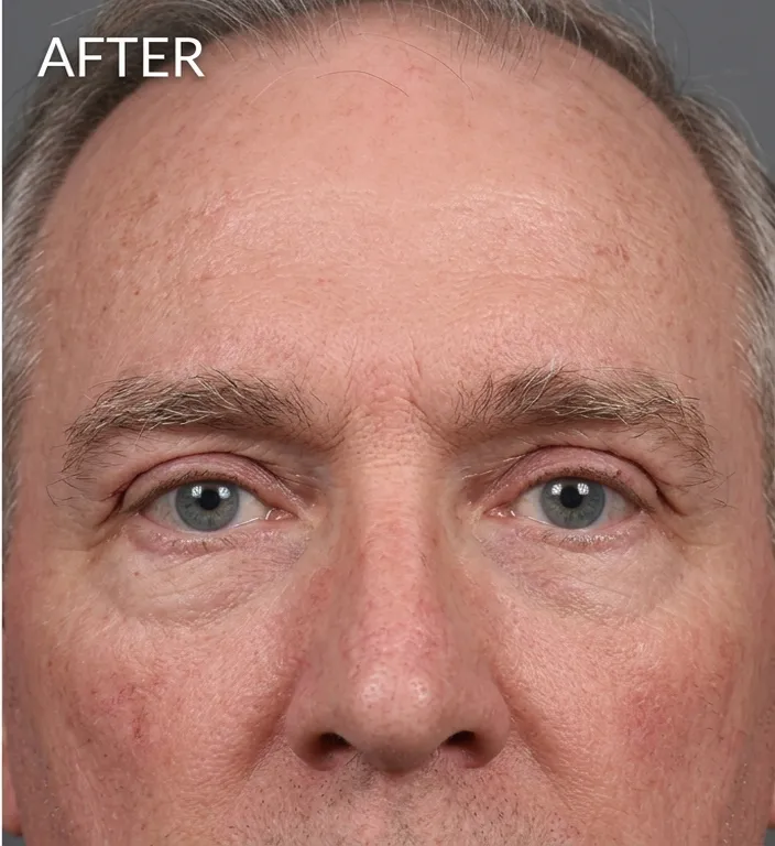 Oberlid Mann nachher